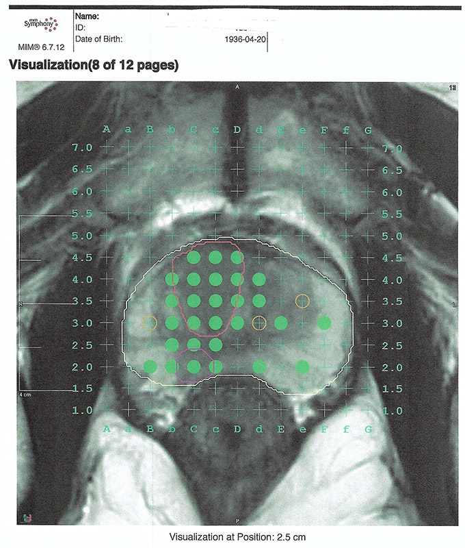 biopsia transperineal próstata mediante fusion rmn