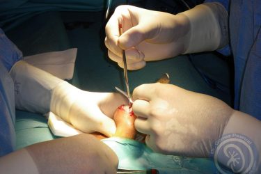biopsia-testicular-incision-2