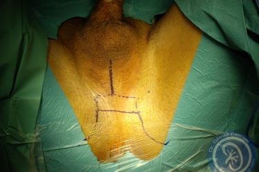 dibujo-antes-de-perineostomia