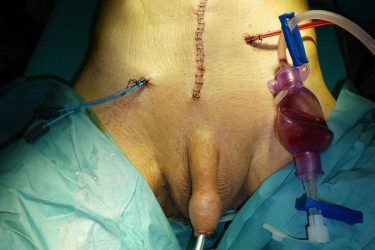 fin-operacion-cistectomia