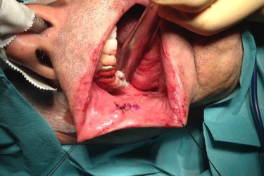 finalizacion-extraccion-injerto-mucosa-oral