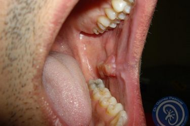 granuloma-postinjerto-mucosa-oral