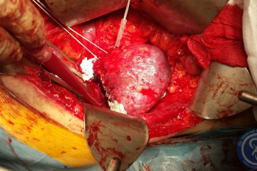 medio-rinon-tras-quitar-tumor