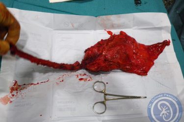pieza-cistectomia-y-ureterectomia