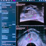 cancer de prostata